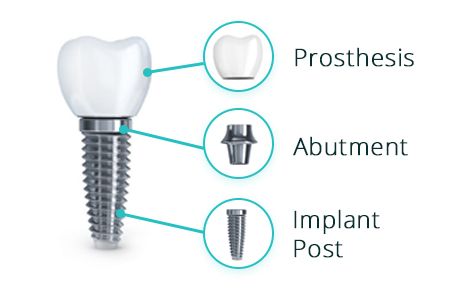 Cost of dental implants in turkey
