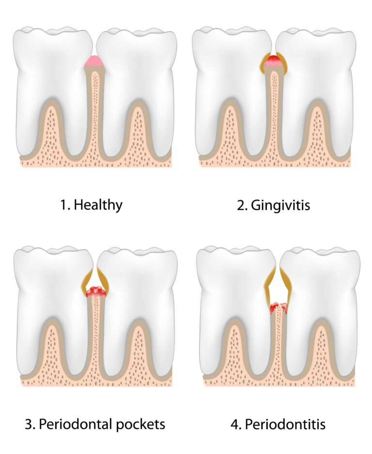 How Gum Disease is Treated