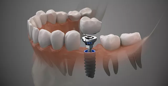 Implants Dental Treatment in Turkey