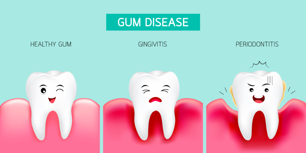 How Gum Disease is Treated