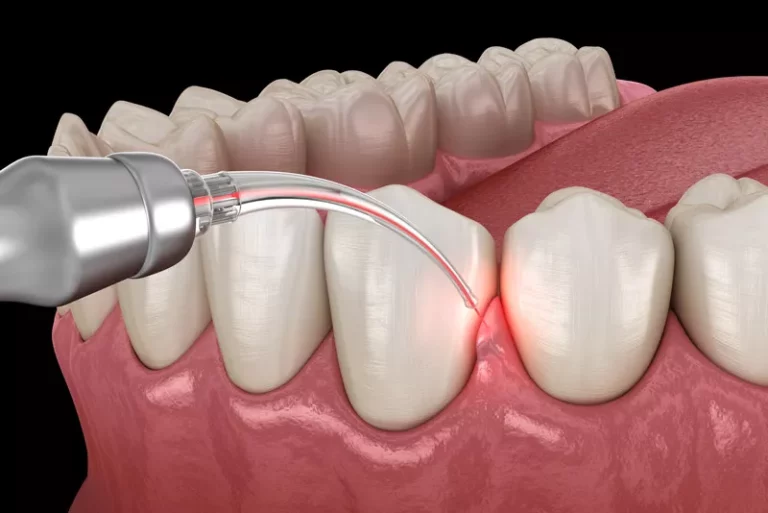Lazer therapy for How Gum Disease is Treated