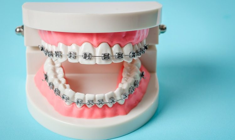 Braces Dental Treatment in Turkey
