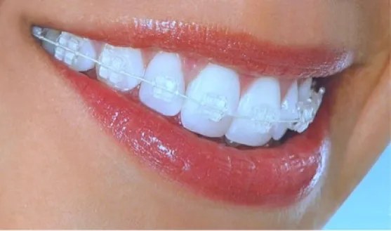 Clear Braces Dental Treatment in Turkey