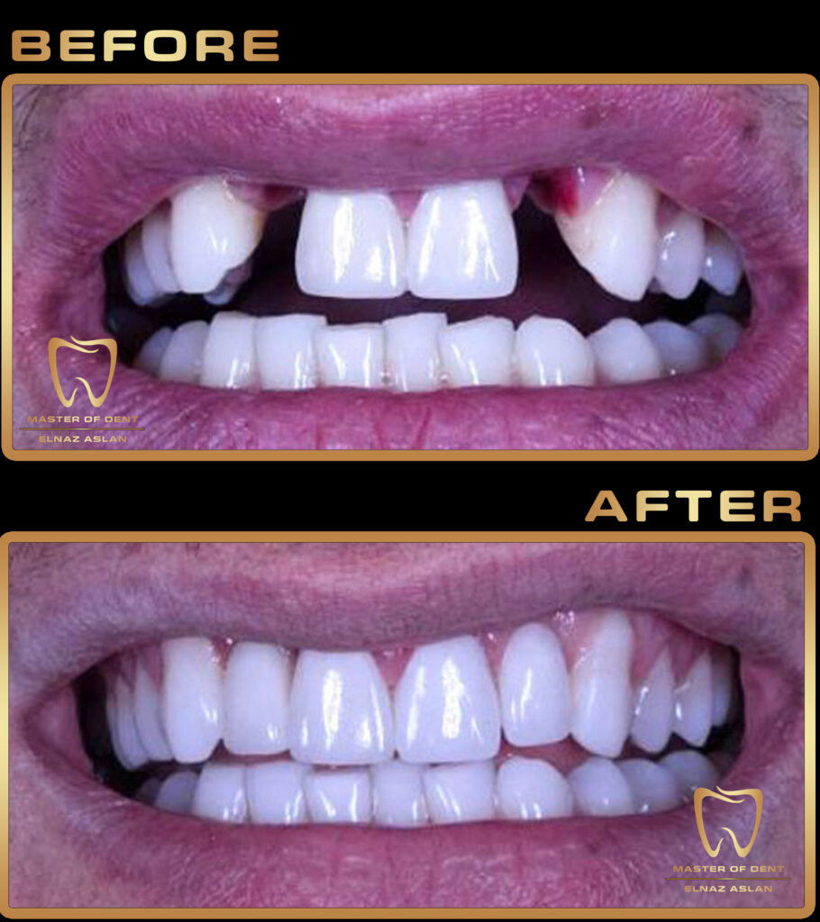 Zirconia crown in turkey