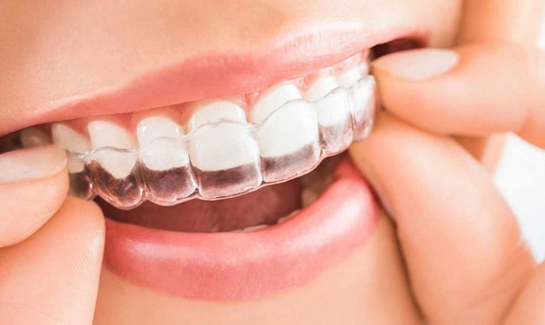 Invisalign Dental Treatment in Turkey