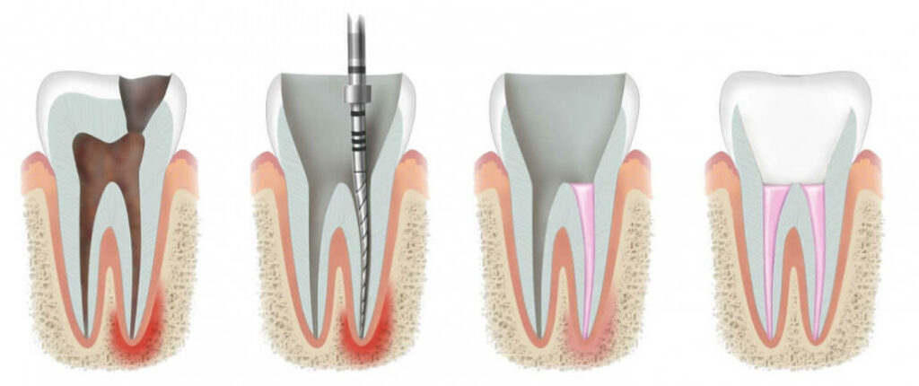 root canal dental work in turkey