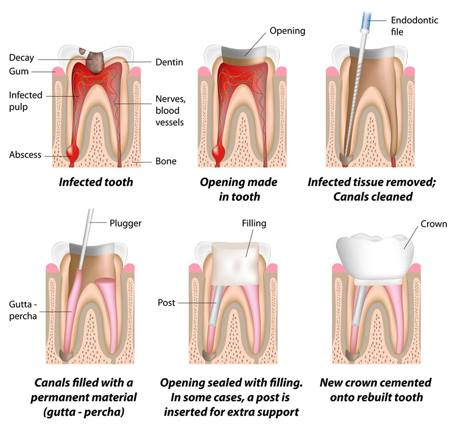 Root canal Dental Treatment in Turkey