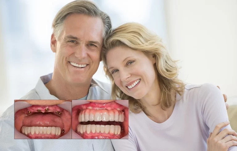 The Benefits of Getting Dental Implants in Turkey