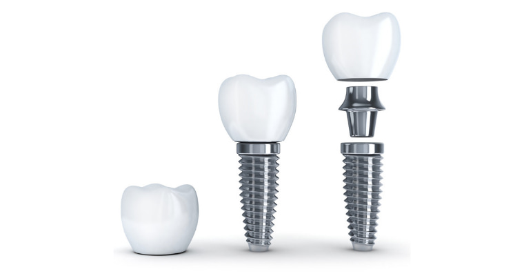 Why are Dental Implants Cheaper in Turkey?