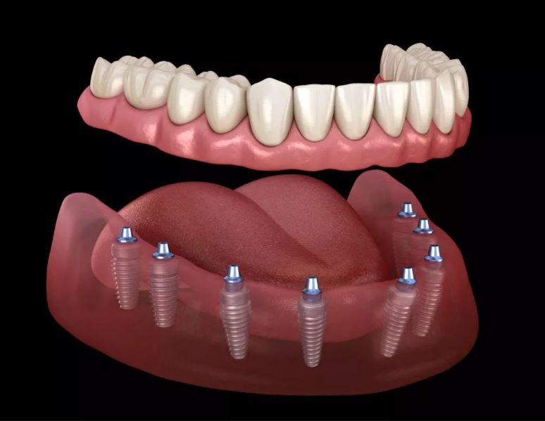 Full Mouth Dental Implants Turkey Package Deals