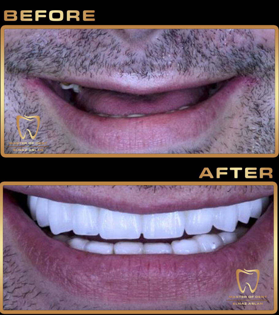 Full Mouth Dental Implants Turkey