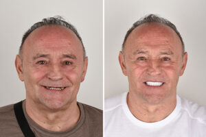 before & after treatment at dentakay